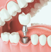 Best Dental Implants Treatment in Brisbane